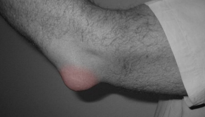 Bursitis - die Schleimbeutelentzündung